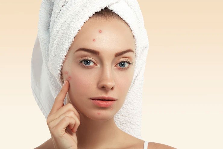 Diccionario-de-radiofrecuencia-facial-imagen-acne